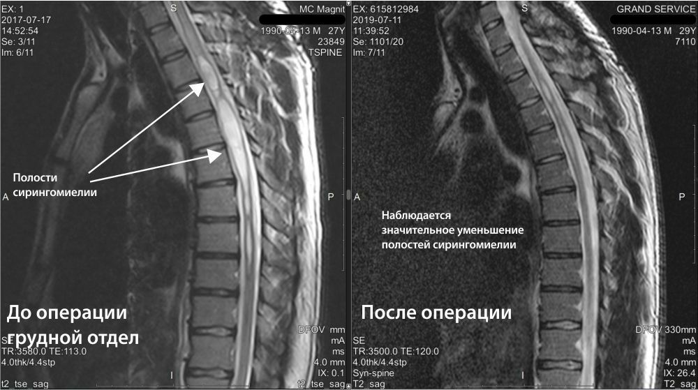 Аномалия арнольда киари операция. Аномалия Арнольда Киари. Сосудистая мальформация спинного мозга. Аномалия Киари спондилограмма.