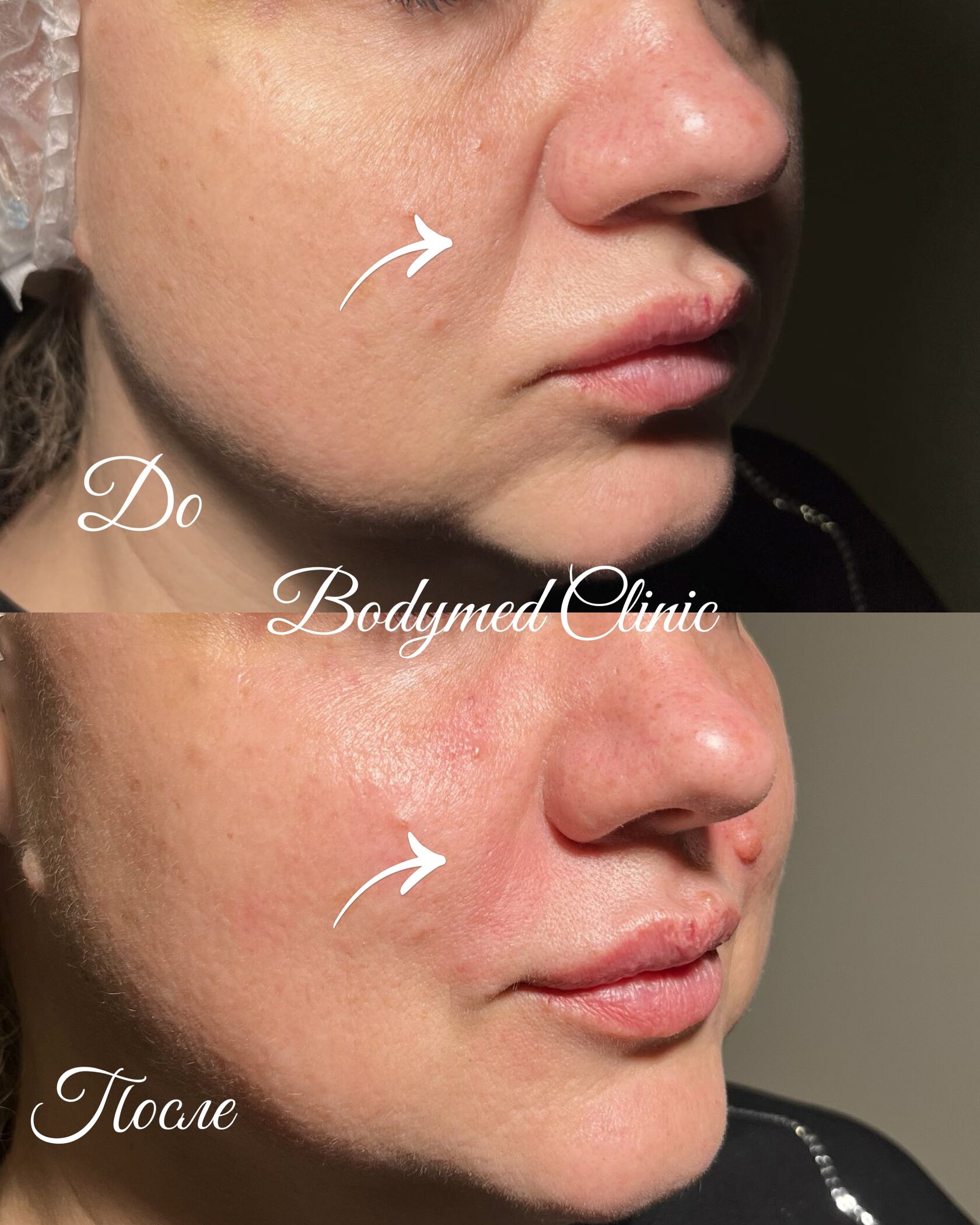 Гармоничное лицо после Full face коррекции