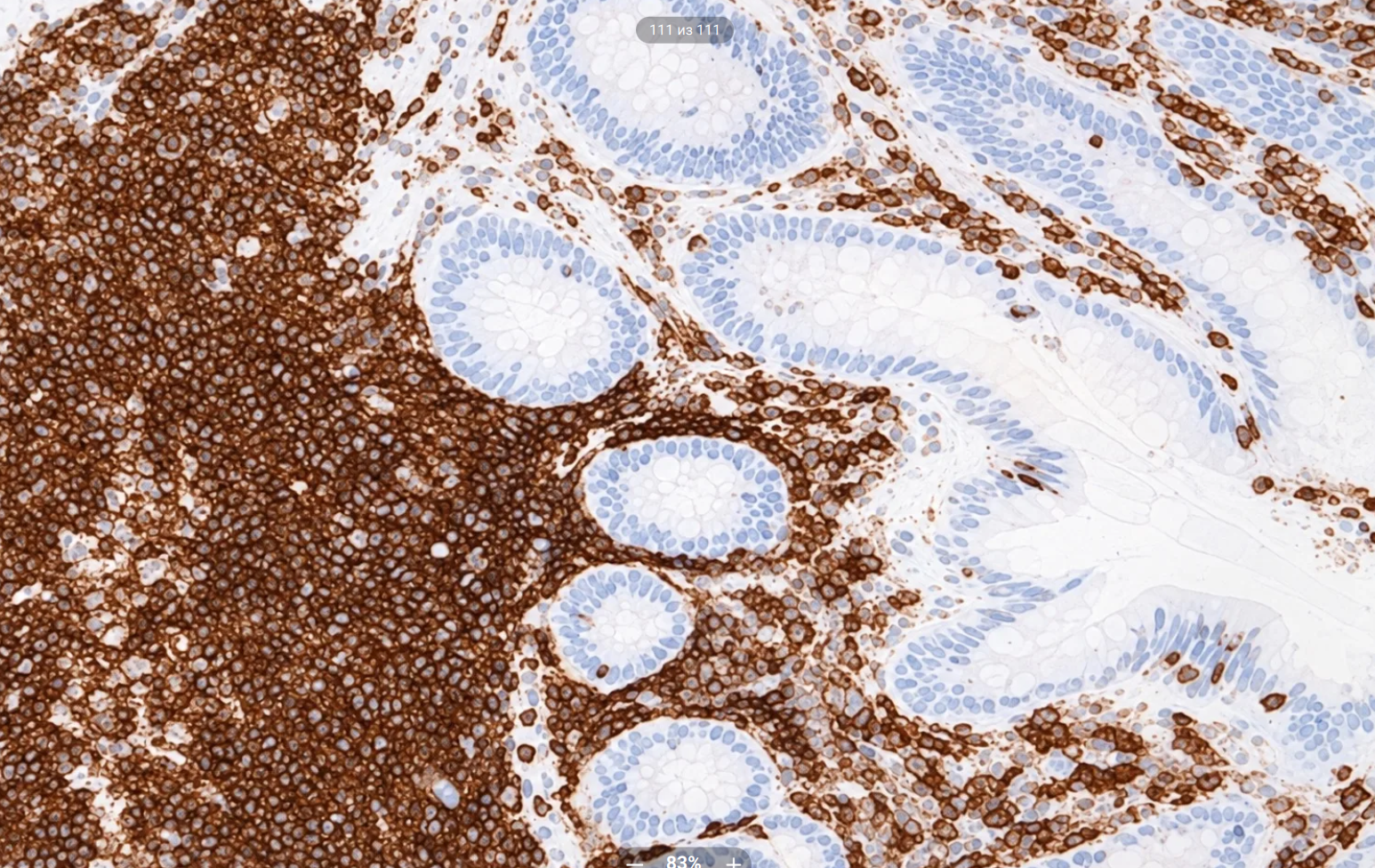 Оптимальное окрашивание CD45 в аппендиксе
