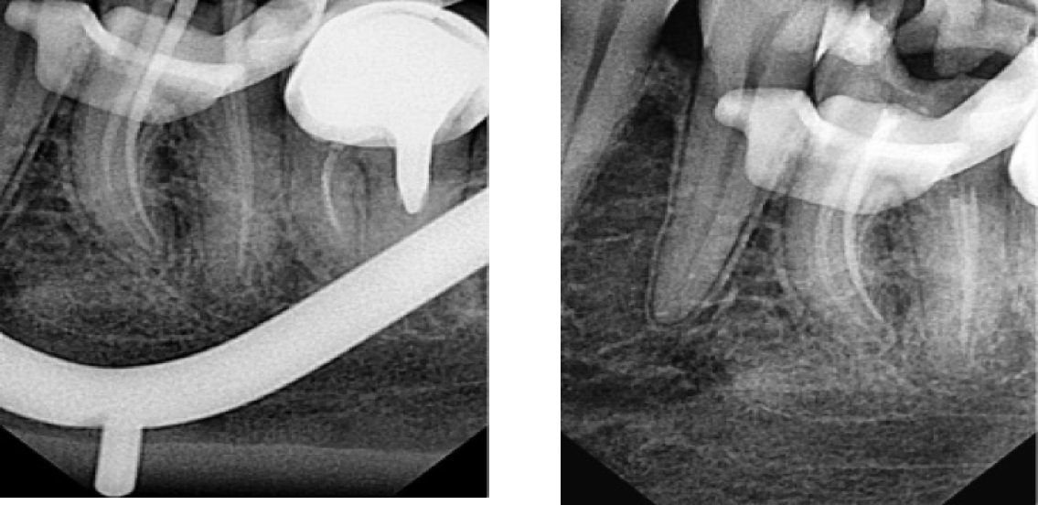 Лечение пульпита - снимок зуба