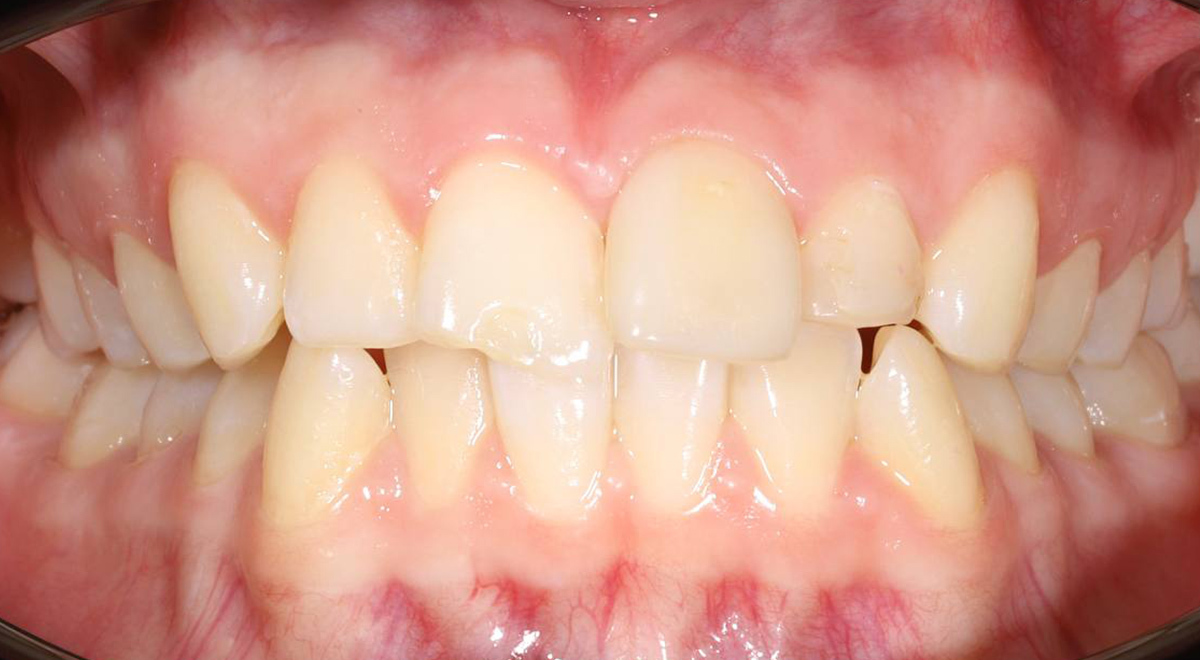 Исправление проблем с прикусом у подростка с помощью несъемных брекетов Damon Q2