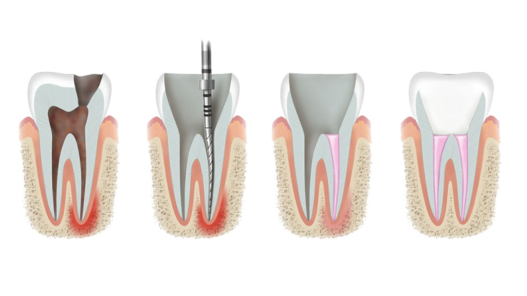 Периодонтит (кисты, гранулемы) лечение — цены и отзывы в Дербенте. Стоматологическая клиника DK