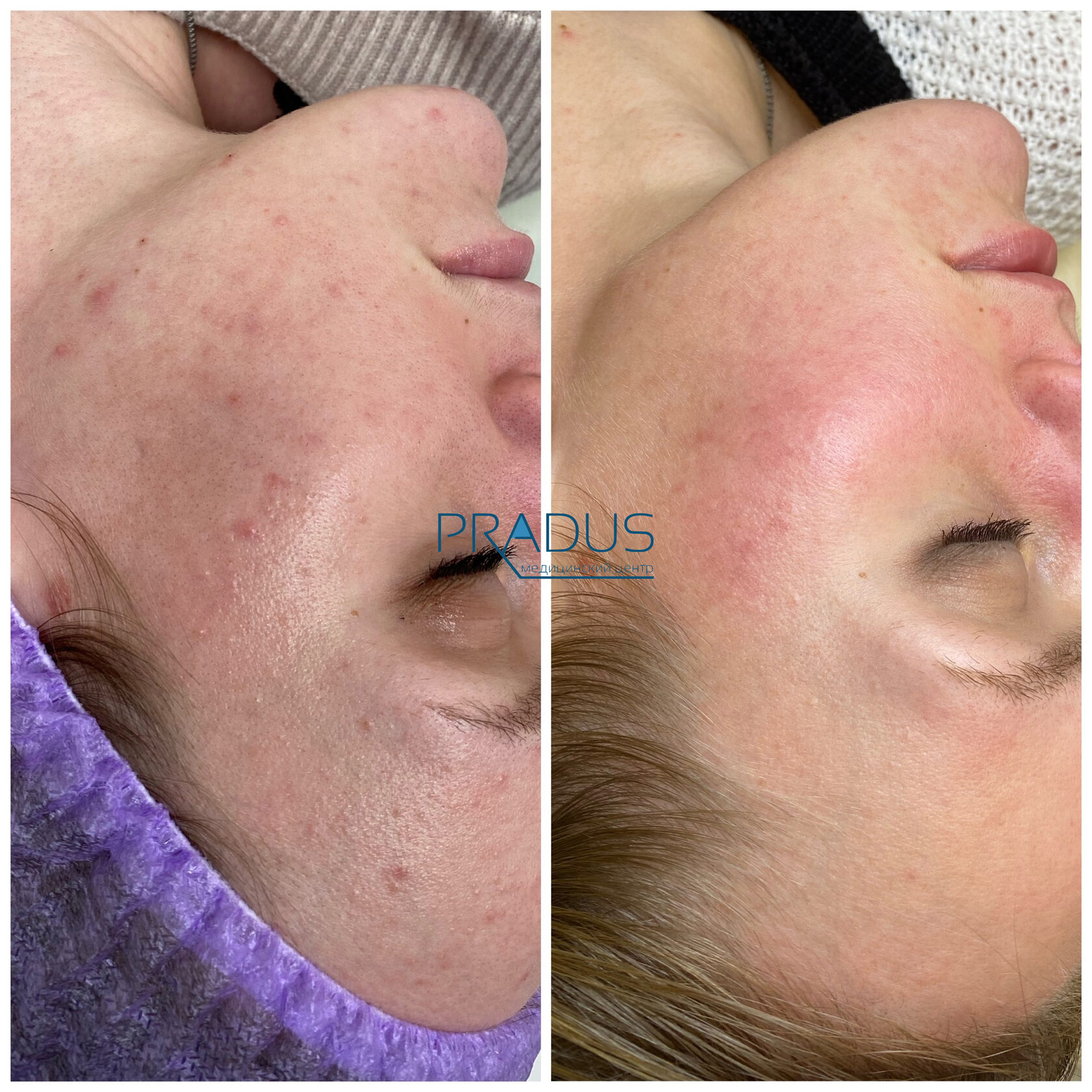 Лечение акне у женщины в клинике PradusCOSMO, СПб. До и после процедуры