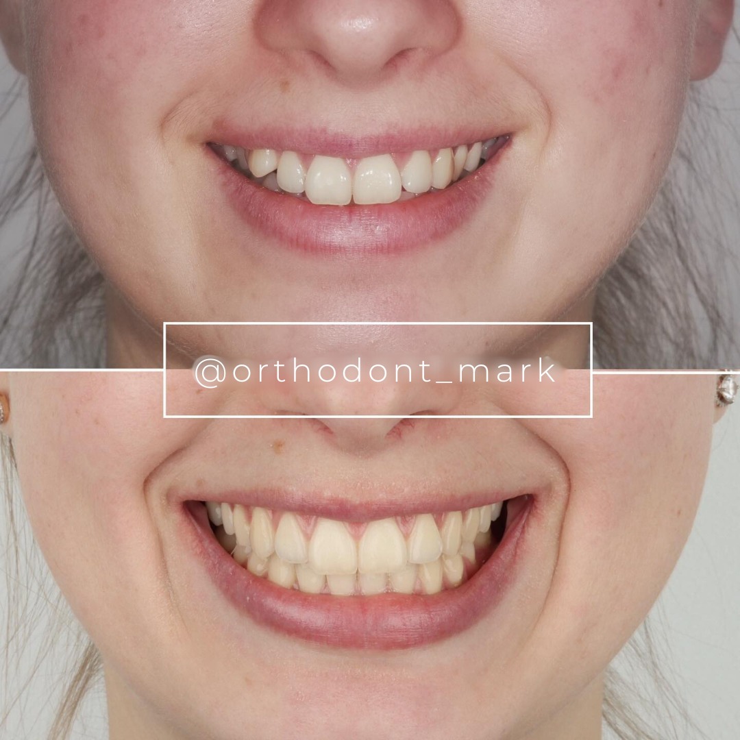 Before and after collage showing the smile achieved through aligner treatment