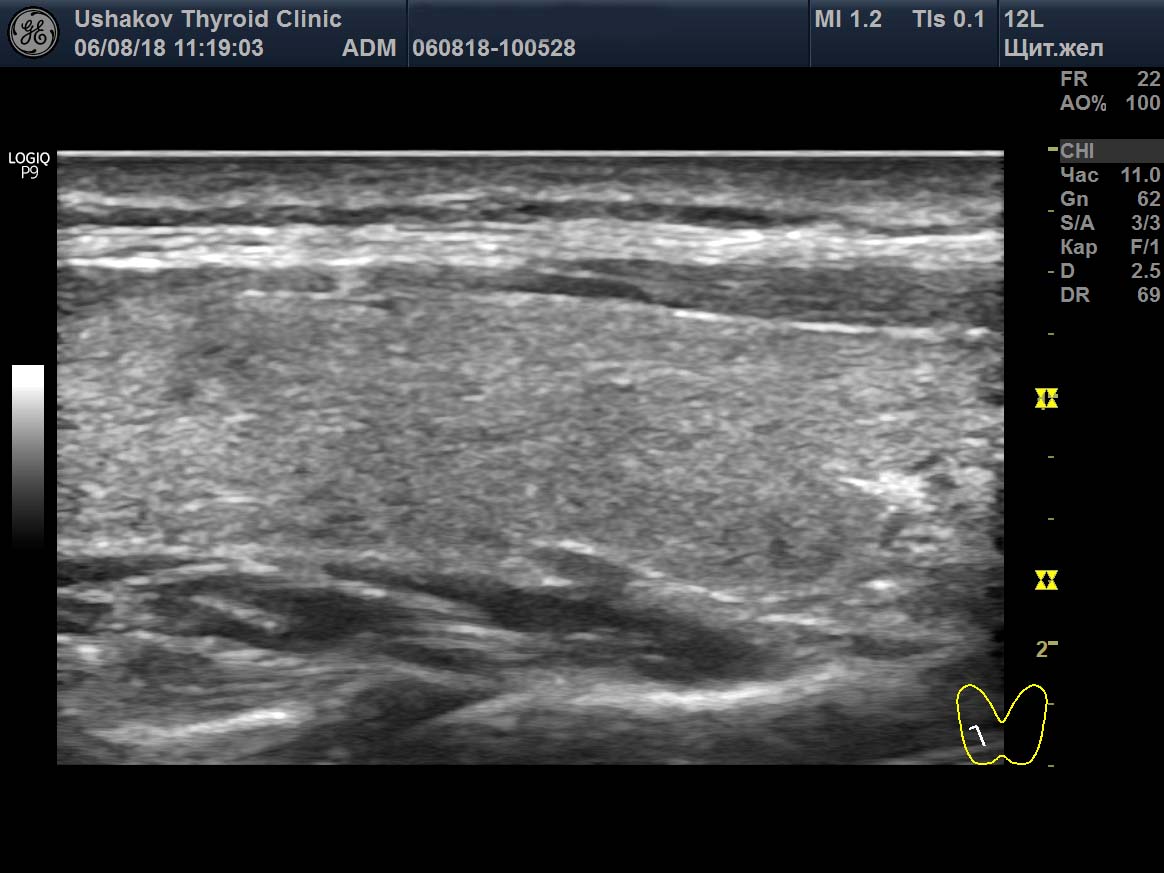 На какой день делается узи молочной железы. Протокол УЗИ молочных желез. УЗИ молочных желёз протокол. Дуктэктазия молочной железы на УЗИ протокол. УЗИ молочных желез Пенза.