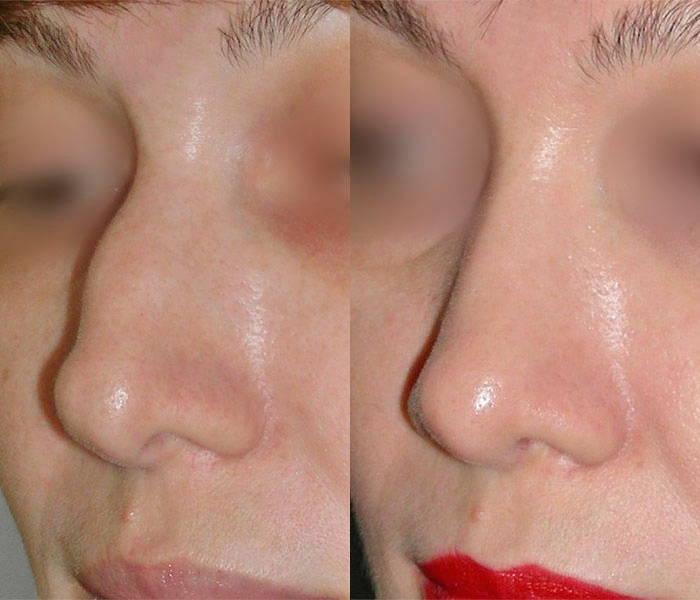 Лазерная ринопластика носа фото до и после