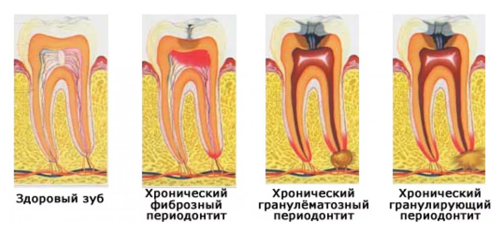 Периодонтите зуба острый лечение. Гранулематозный периодонтит периодонтит гранулематозный. Классификация кариес пульпит периодонтит. Формы хронического гранулематозного апикального периодонтита. Хронический периодонтит пульпит.