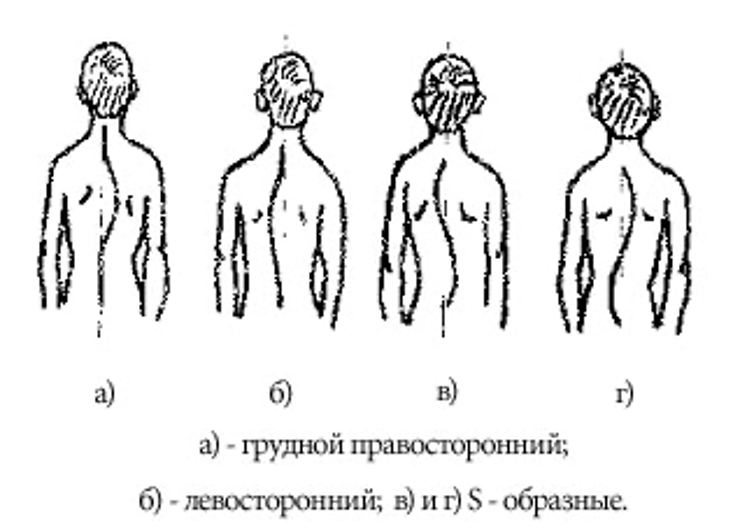 Сколиоз 1 степени группа здоровья. Типы осанки человека. Форма спины. Формы спины у человека. Сколиотическая форма грудной клетки.