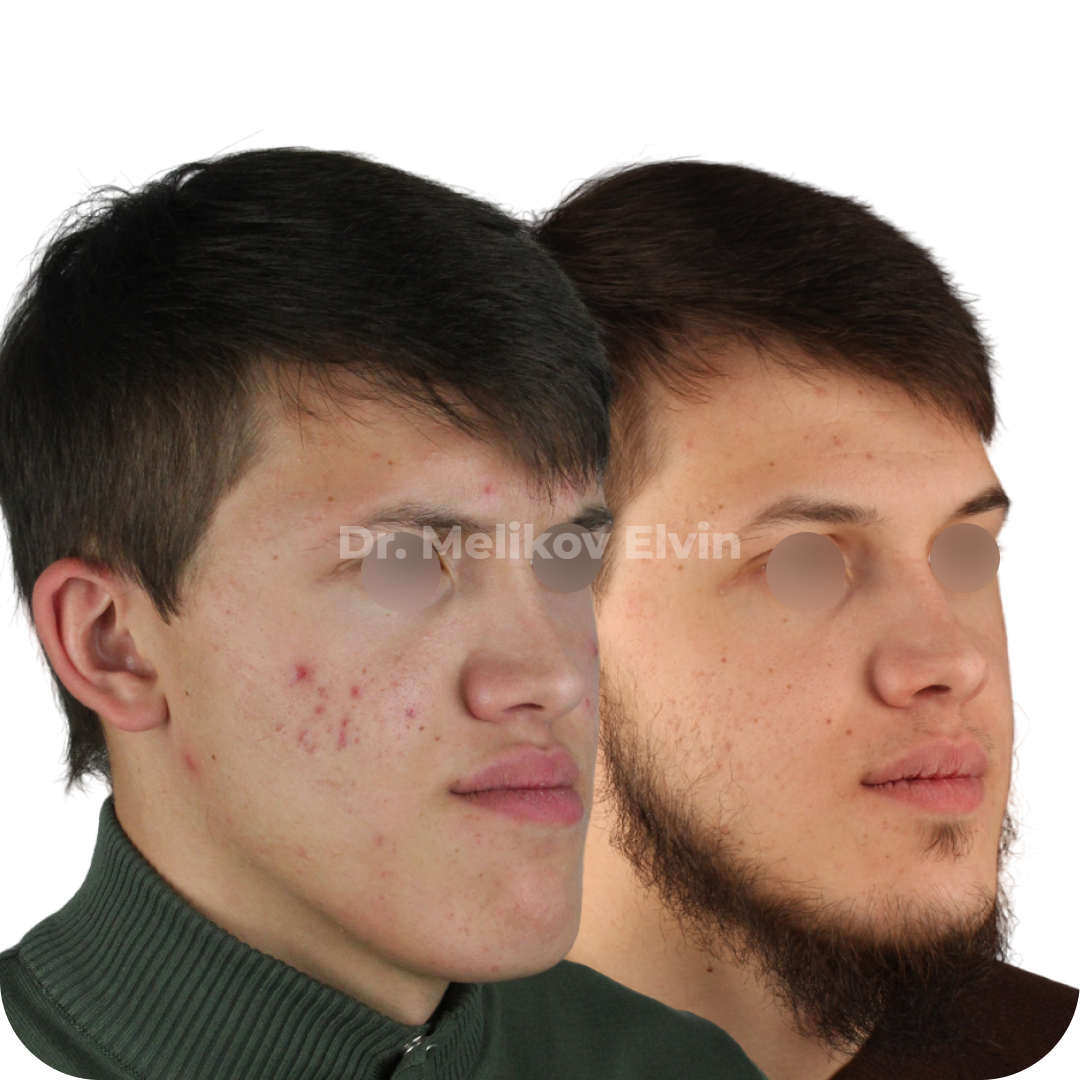 Мезиальный прикус