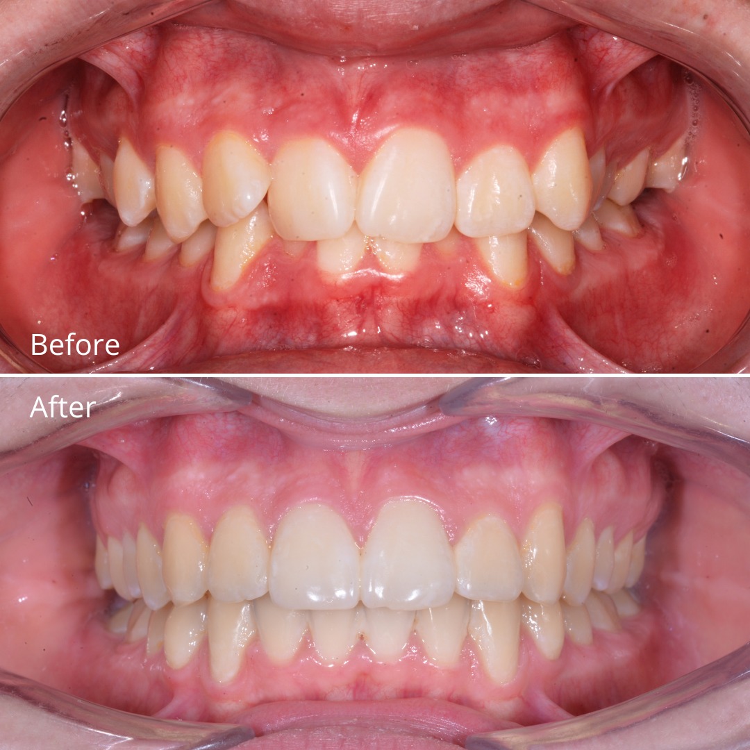 Stage photo showing bite and arch correction during Damon system treatment — photo 2 of 3
