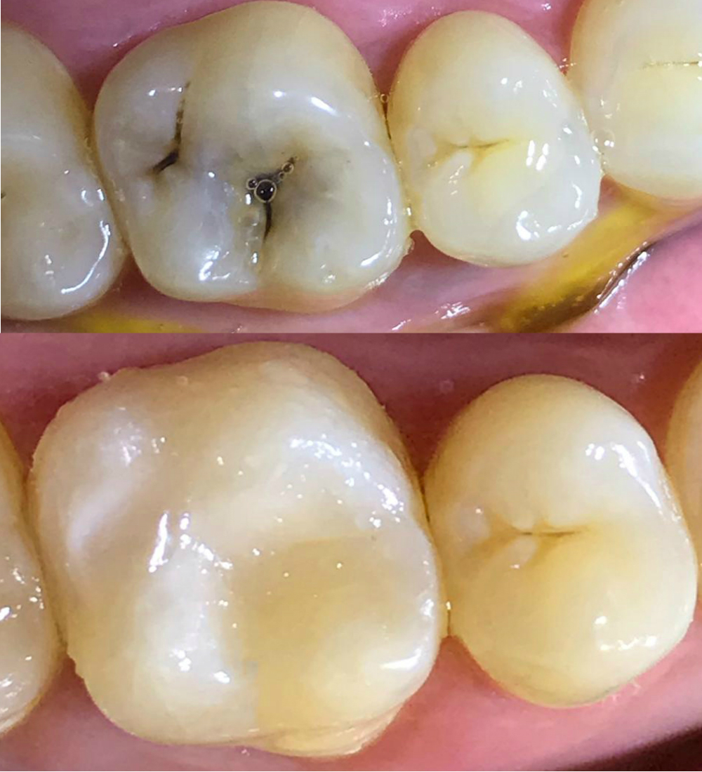 Примеры выполненных работ, фото до-после работ врачей семейной стоматологии Зубной Патруль