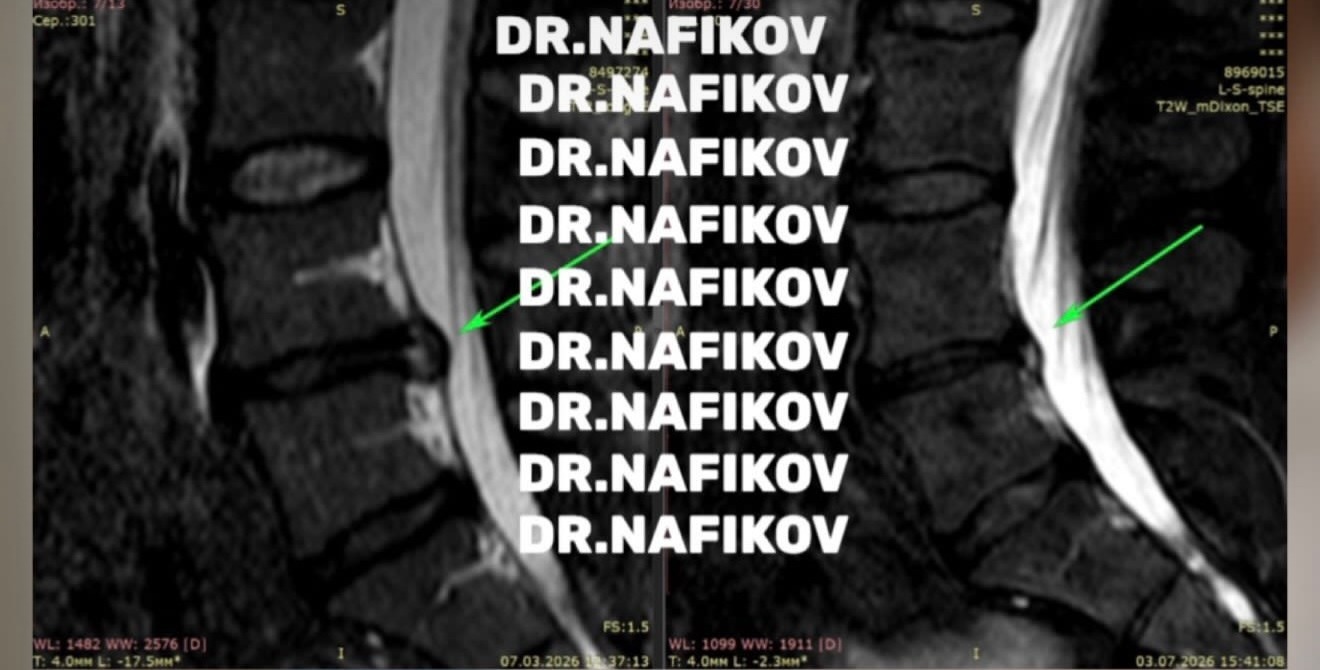 МРТ до и после лечения, Пациент А., 42 года