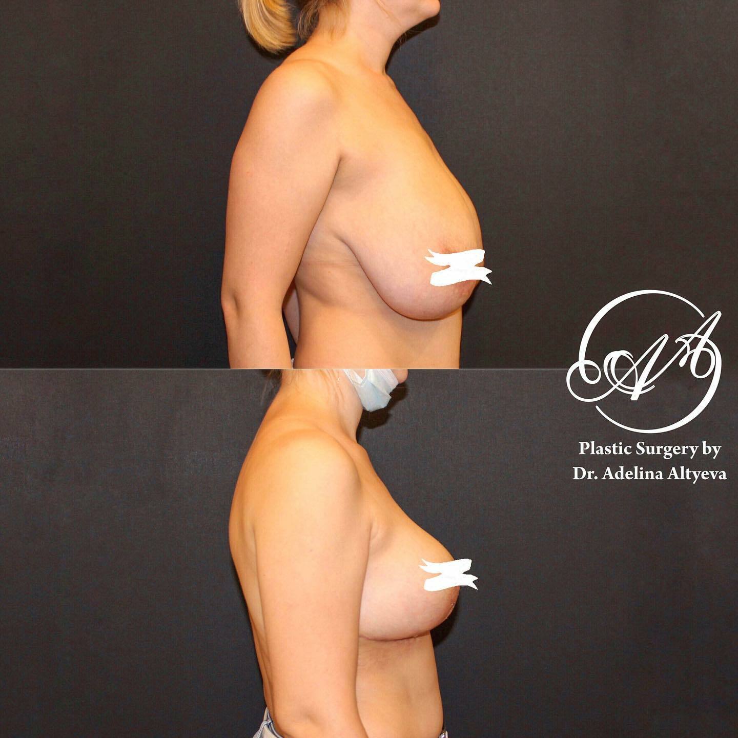 уменьшение груди у женщин фото 17
