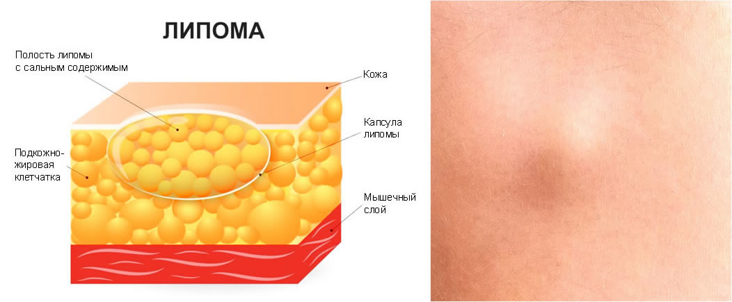 Остеохондромы, липомы, гемангиомы, мезенхиомы кисти