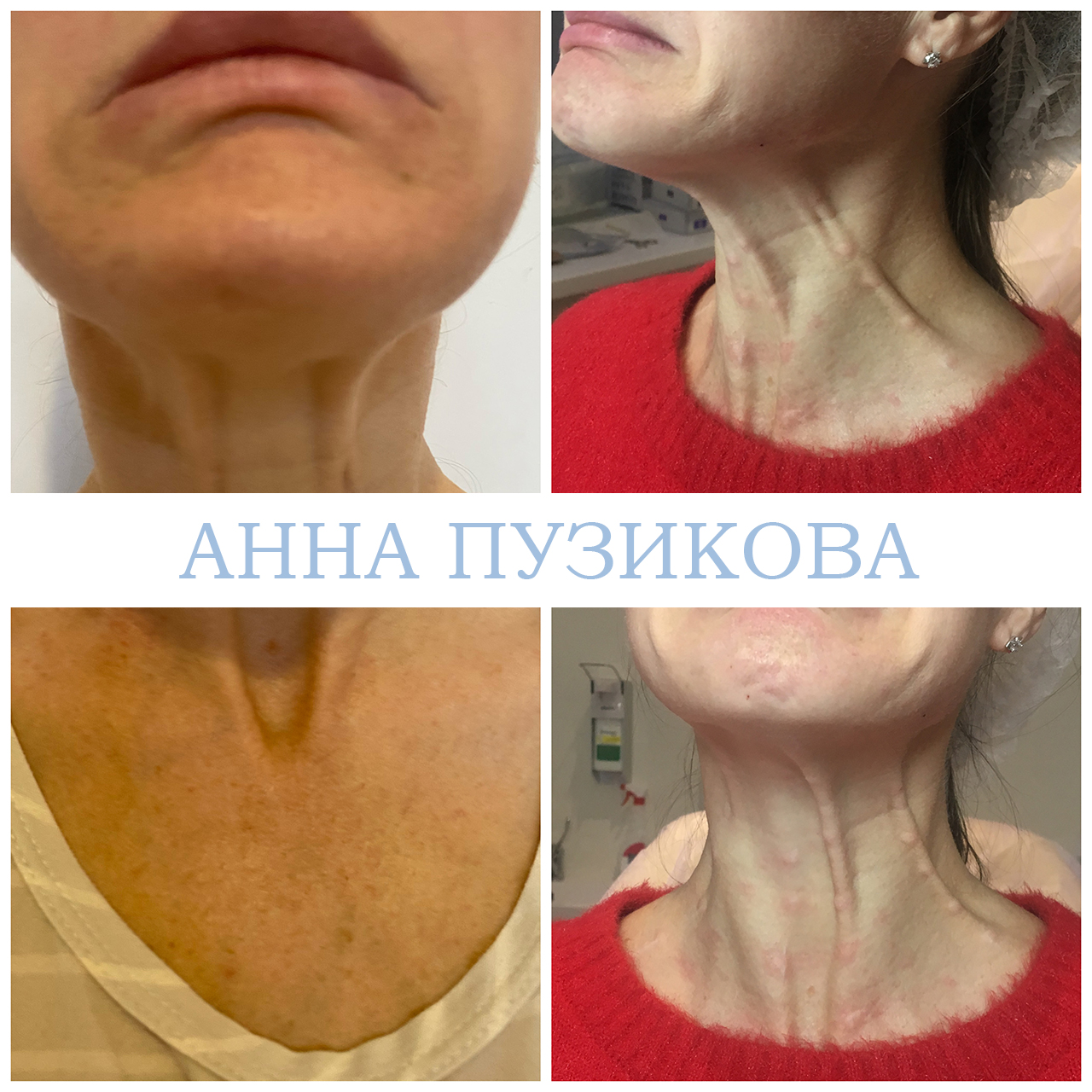 Результат ботулинотерапии — коррекция мимических морщин на лбу и в области глаз. Косметолог Пузикова Анна Анатольевна, Санкт-Петербург