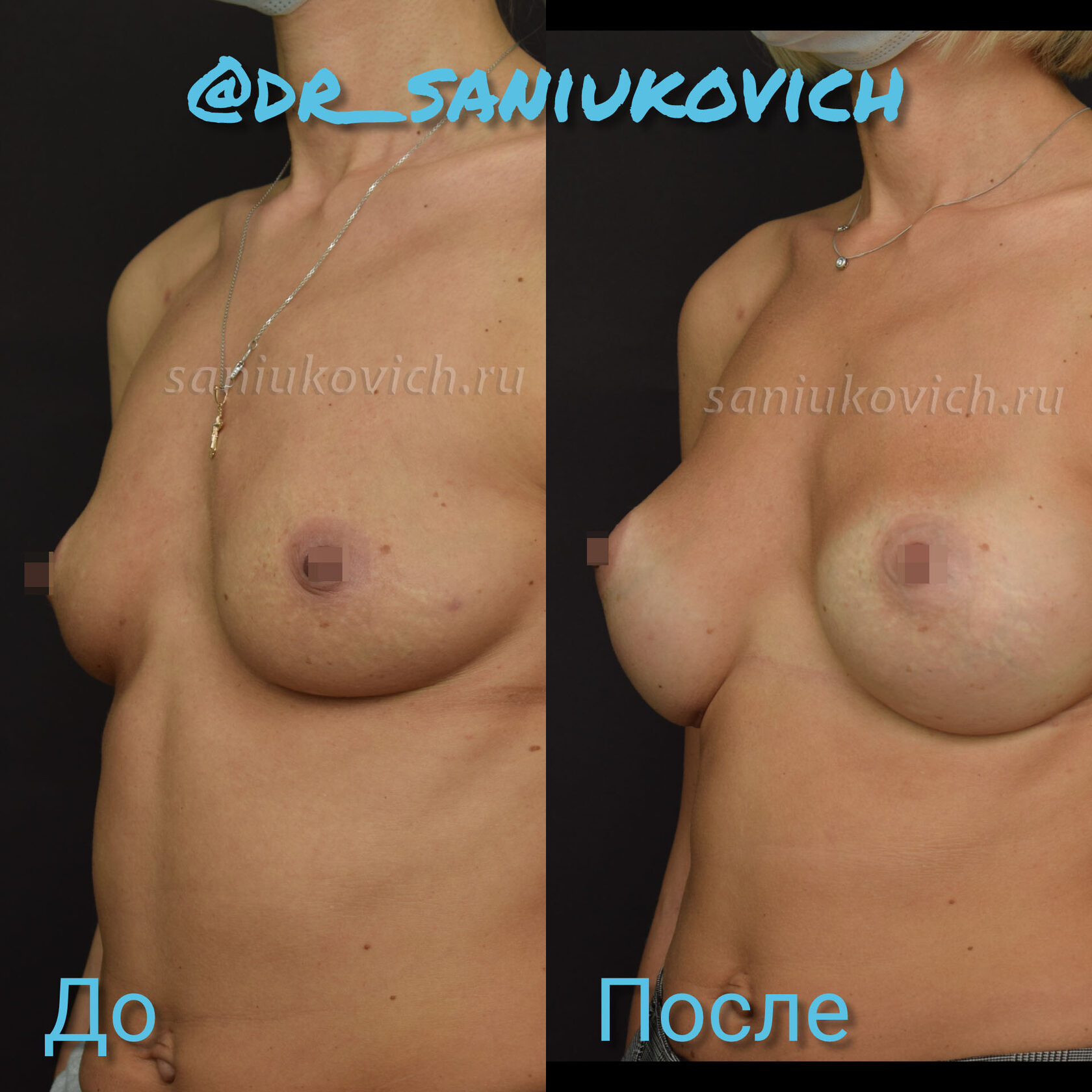 удаление импланта груди у женщин фото 8