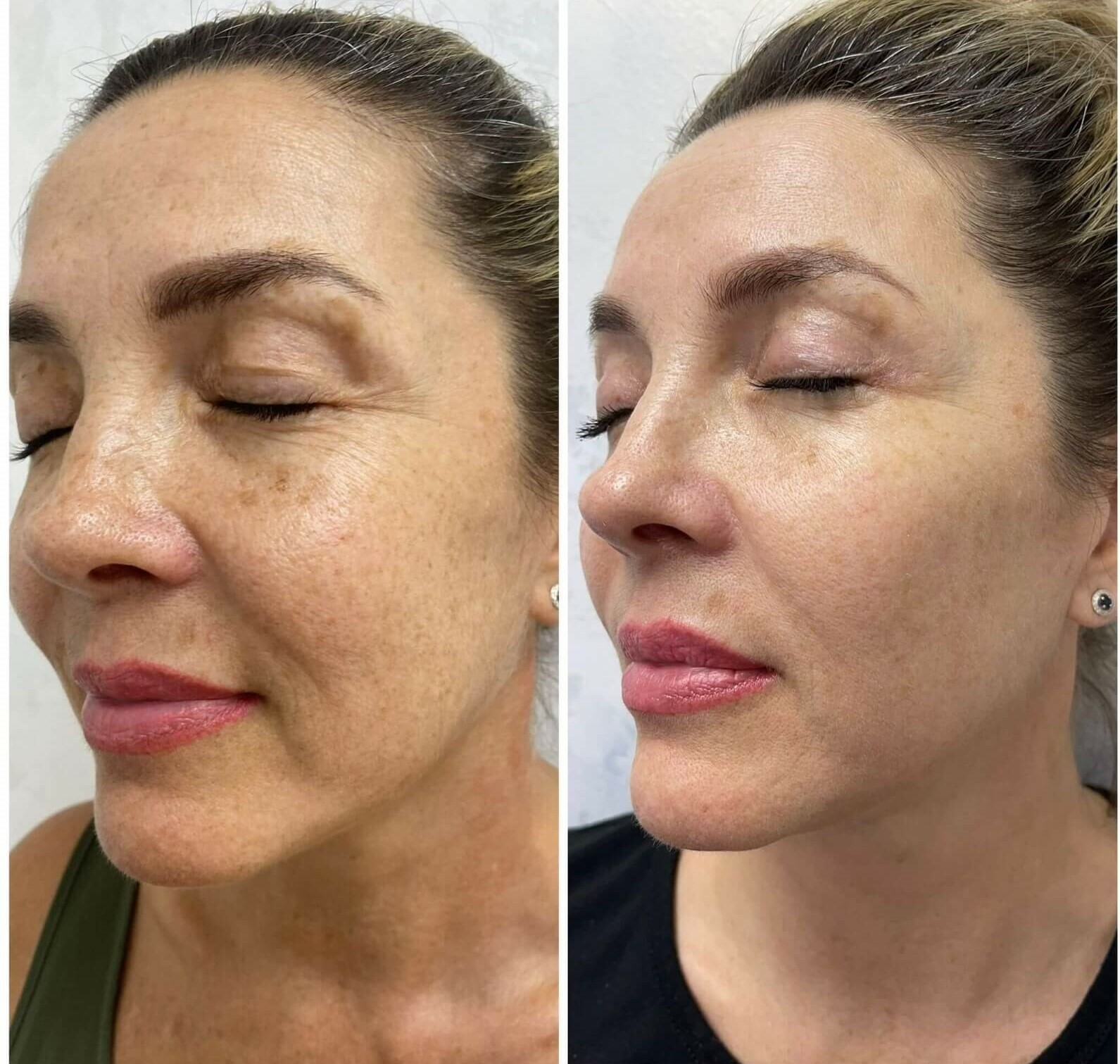 Hyperpigmentation treatment in Hallandale, Miami, Fort Lauderdale
