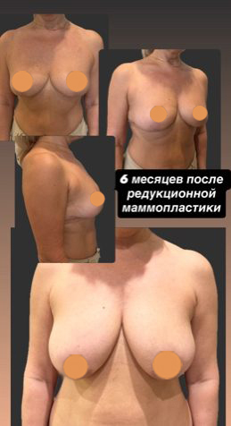 Подтяжка груди, результат