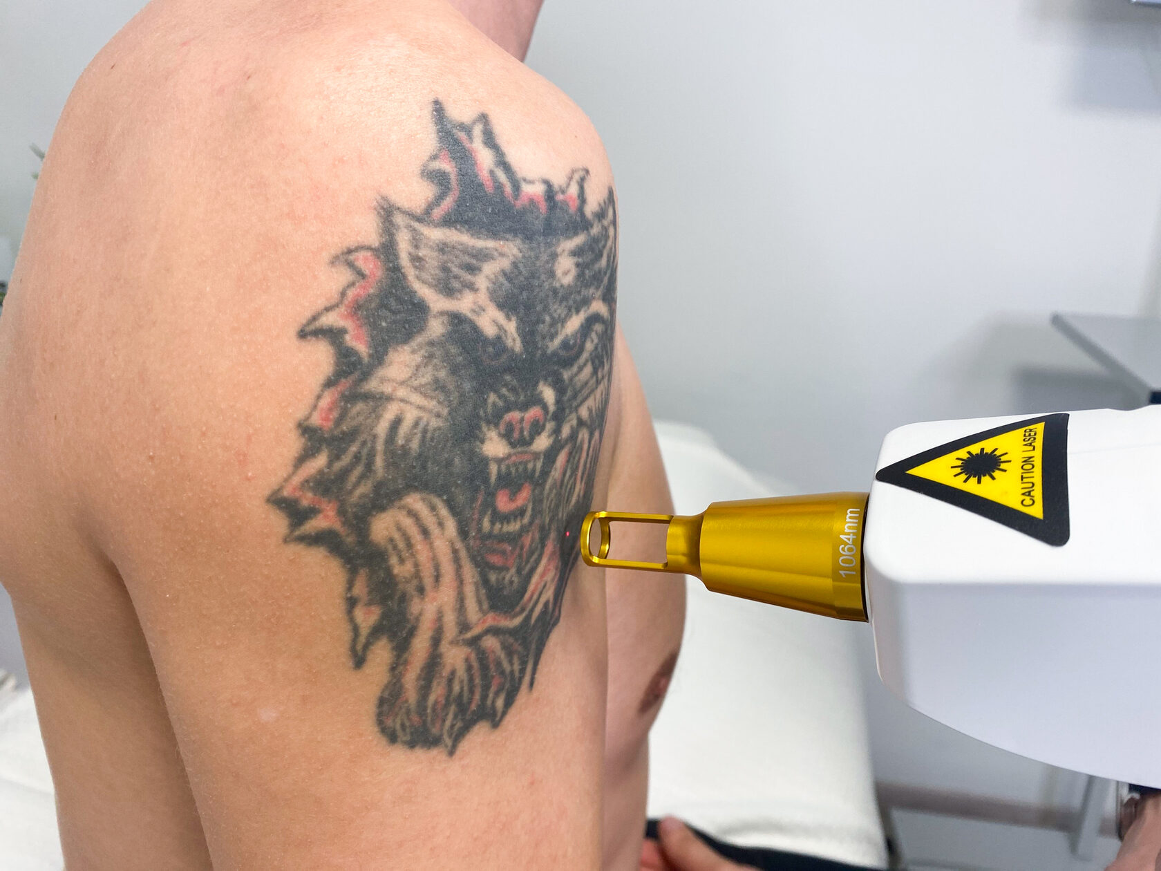 Удаление тату неодимовым. Пикосекундный лазер для удаления татуировок разбитое фото.