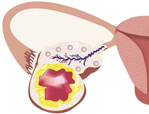 Киста Желтого Тела Яичника: Симптомы, Причины, Лечение
