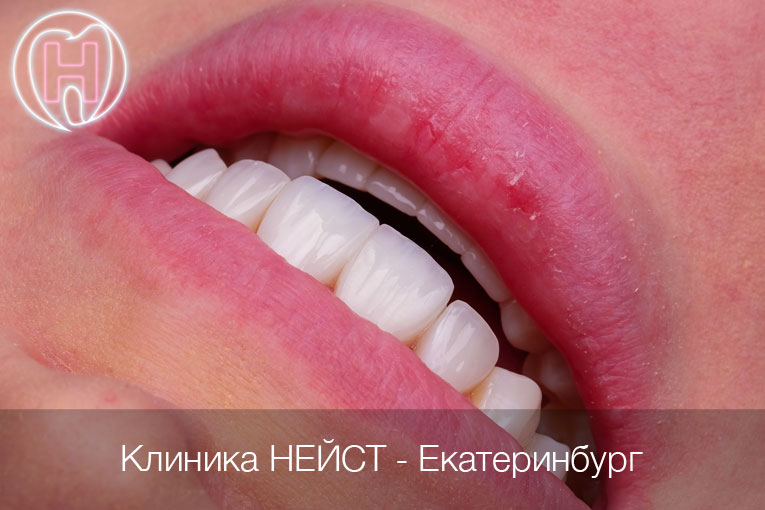 Натуральные композитные виниры в Екатеринбурге, цвет Блич 4