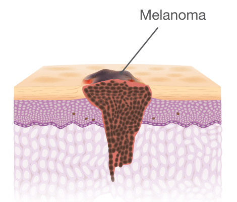 Risk factors for melanoma