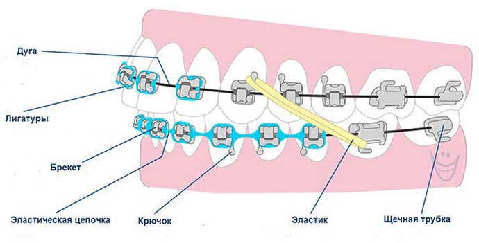 Эластики для брекетов схемы