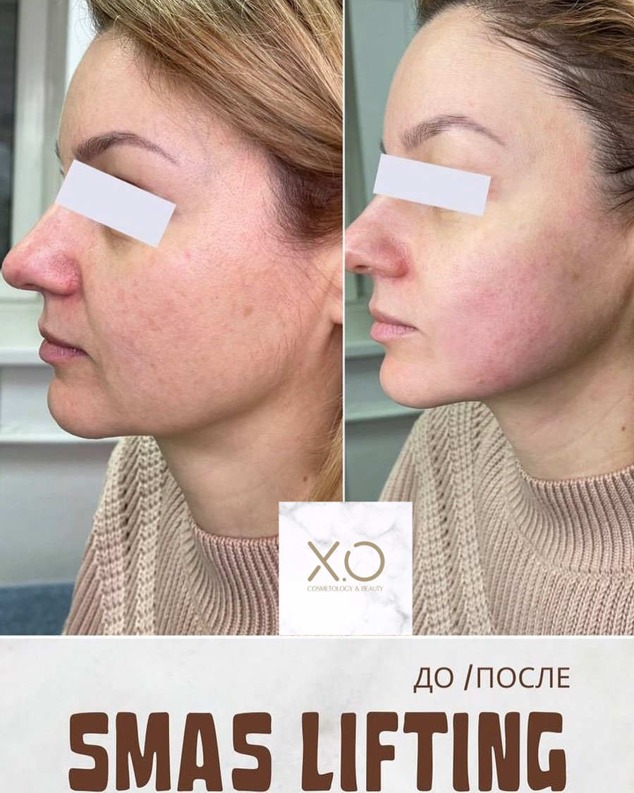 Ultraformer: non-invasive SMAS lifting - Beauty Concept Moscow:  Результативная косметология (LipsClinic)