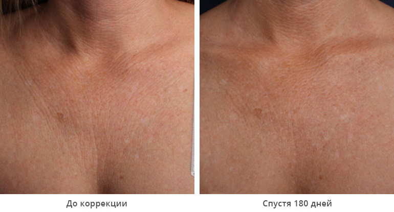 Фото груди генсухи до и после SMAS лифтинг Ultherapy