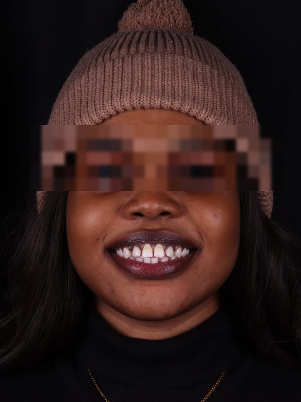 Исправление прикуса — фото до лечения, Elite Denta