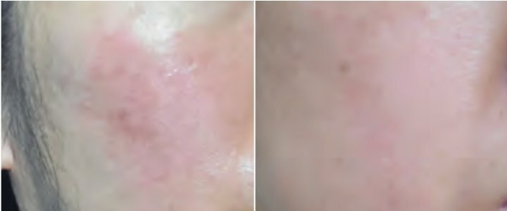 Раздражённая кожа до и после крема PLONTE