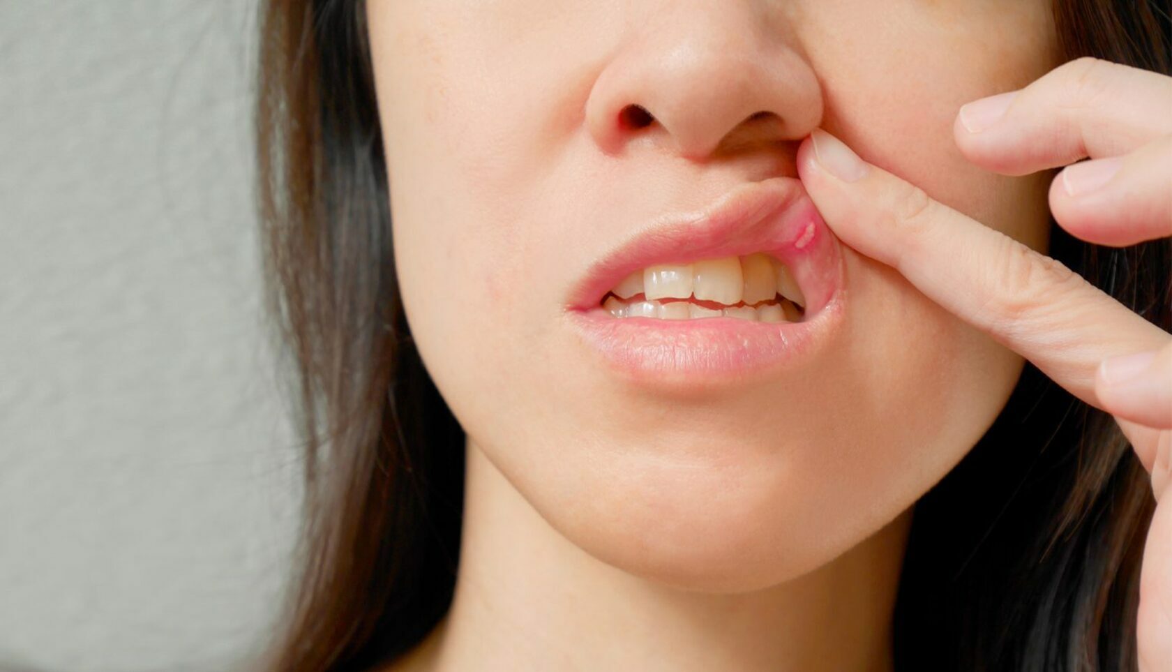 Почему появляются язвы во рту и как их лечить
