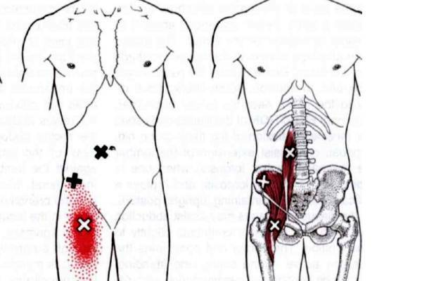 Триггерные точки на теле человека фото с описанием для снятия боли в бедре