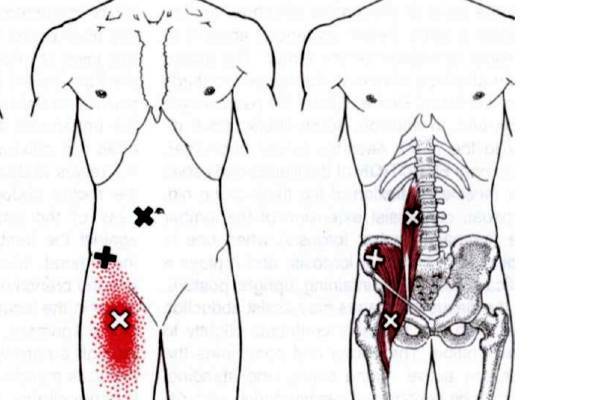 Илеопсоит: воспаление подвздошно-поясничной мышцы