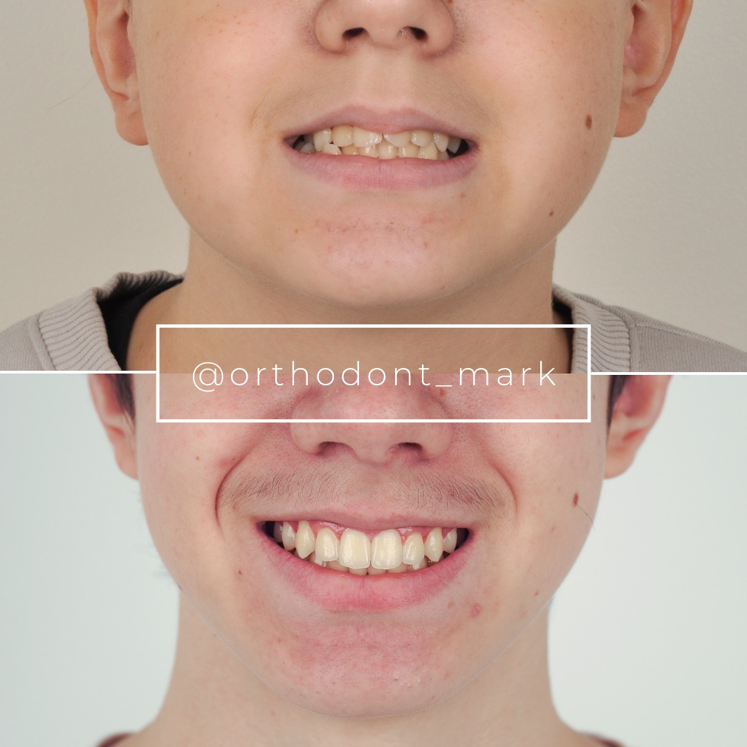 Skeletal Crossbite and Crowding Corrected at Peak Growth