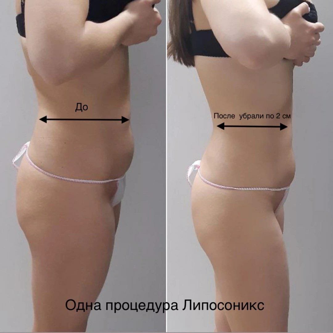 Липосоникс отзывы фото до и после