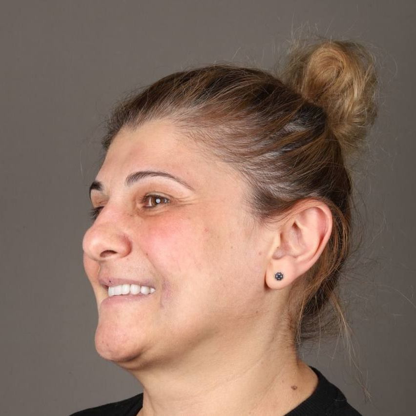 All-on-4, All-in-4 имплантация, протезирование, вернуть зубы, протезирование на имплантах, всё-на-4, все-на-четырех, протезирование зубов