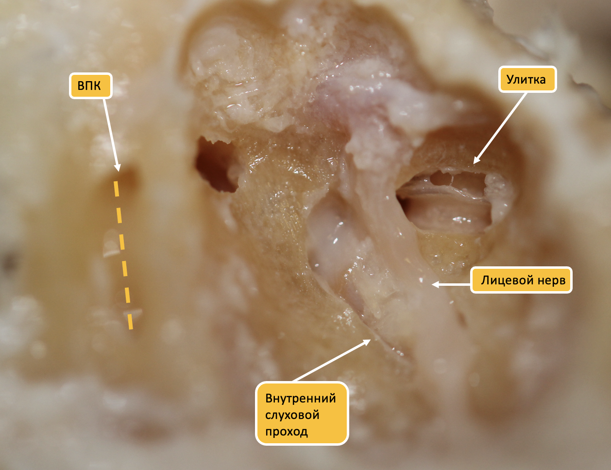 внутренний слуховой проход; лицевой нерв; верхний полукружный канал; ВСП; вестибулярная шванномаIAC; cochlea; facial nerve; geniculate ganglion
