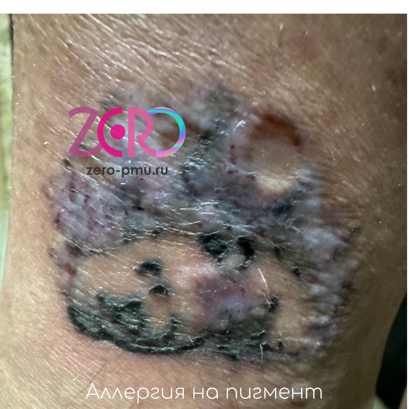 Аллергия на татуировку