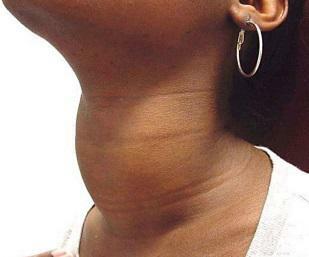 болезни щитовидной железы-последствия дефицита содержания йода в воде