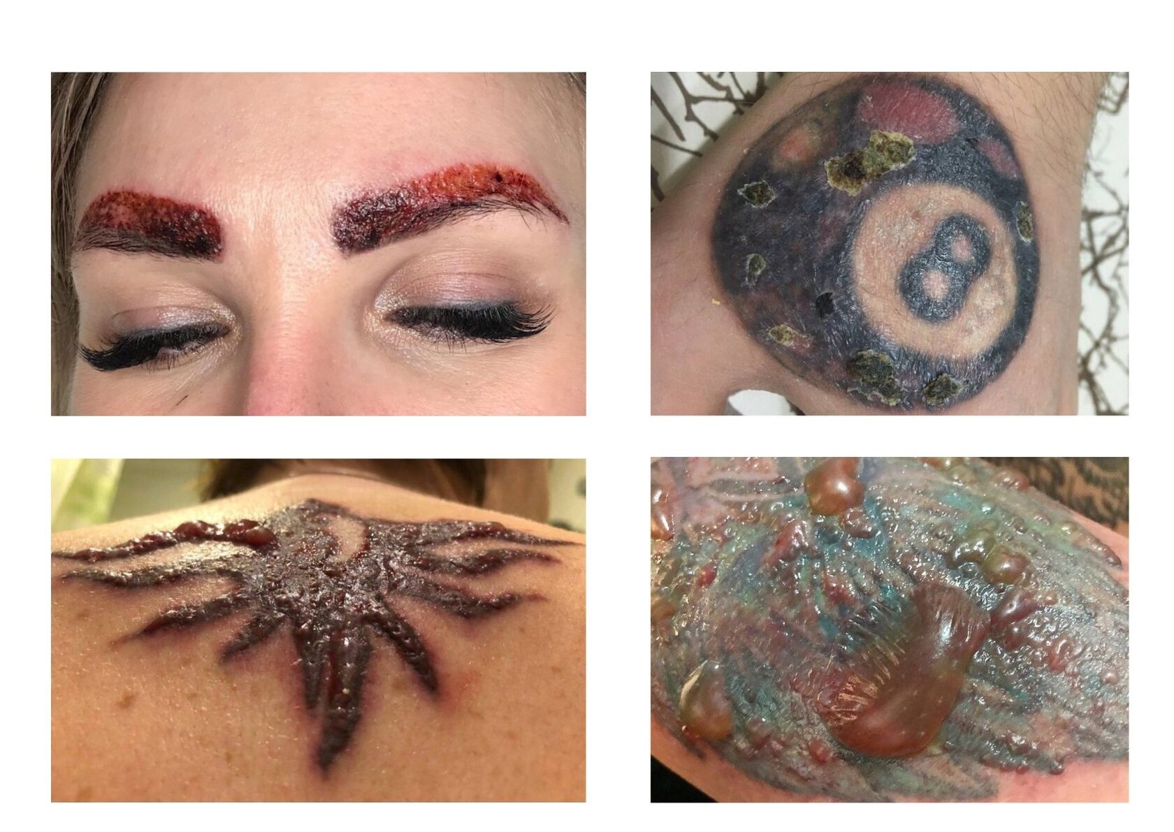 ожоги и шрамы после неграмотного лазерного удаления татуажа и татуировок