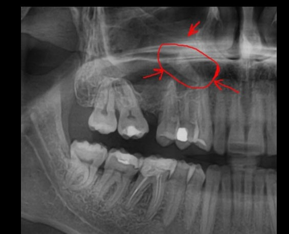 рентгеновский снимок челюсти