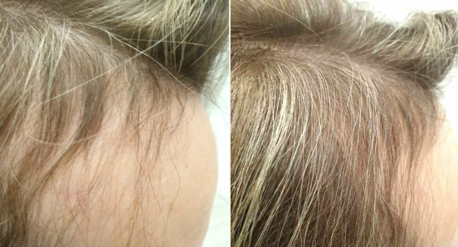 Эффект после курса процедур Дермадроп от выпадения волос до и после
