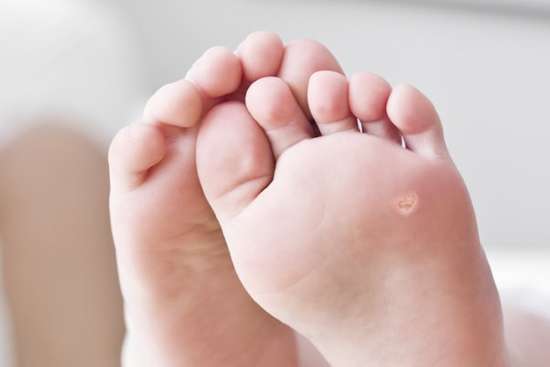 Бородавка на ноге у ребенка