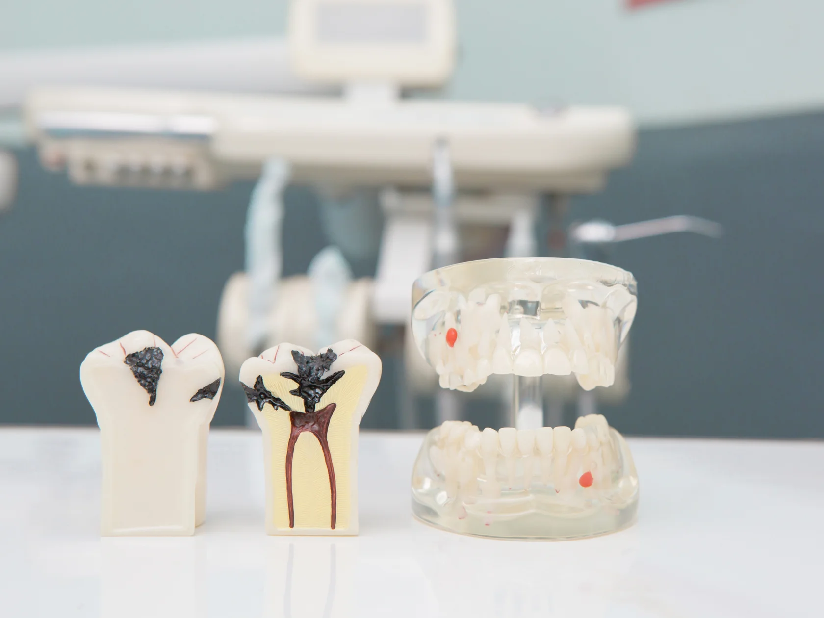 Модель зуба с кариесом и воспалённой пульпой рядом с макетом челюсти для наглядной демонстрации мифов и реальных методов лечения пульпита в клинике «Элегия»