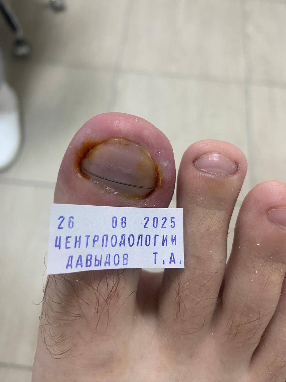 лечение вросшего ногтя в курске