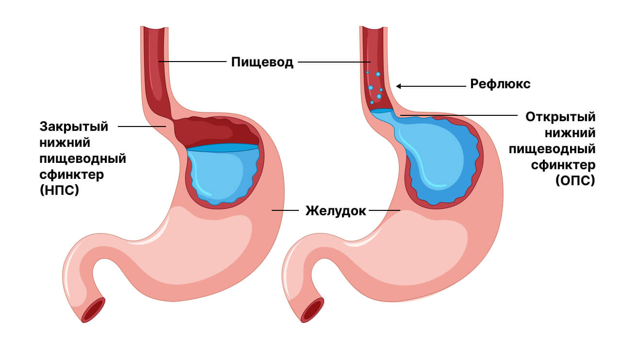 Рефлюкс вен