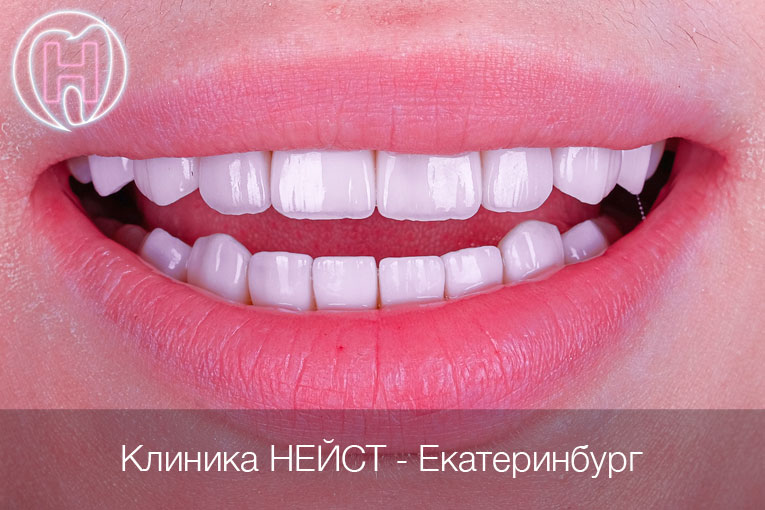 керамические виниры Эстетик цвет Блич 3 (Bleach3)