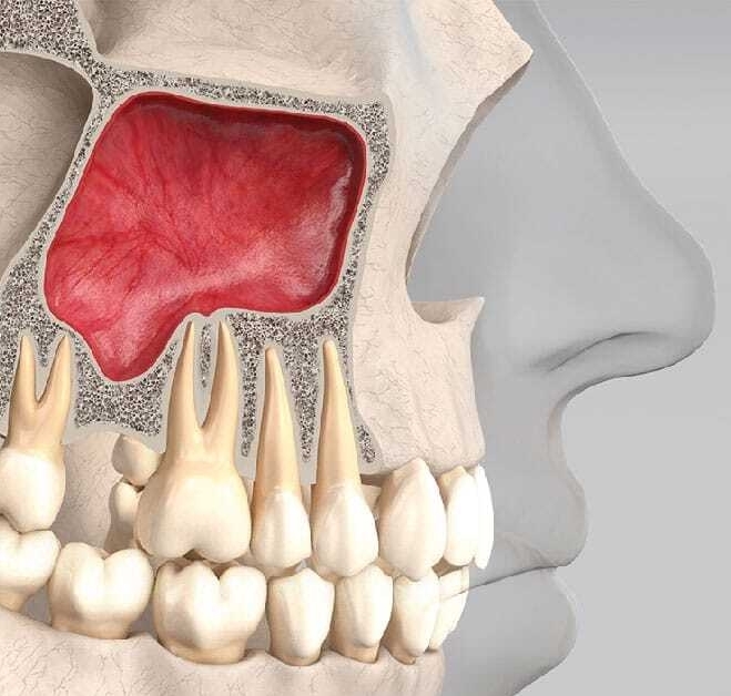 Последствия перфорации гайморовой пазухи после удаления зуба