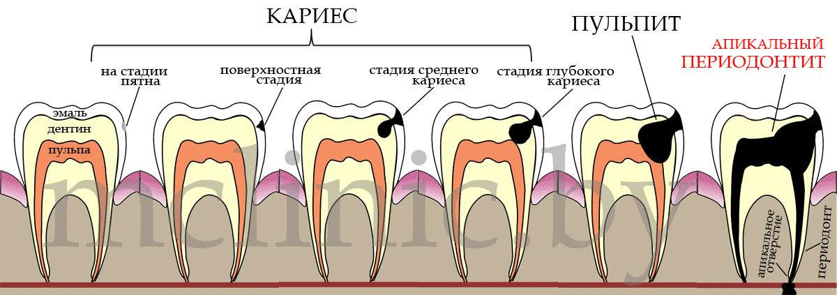 Фазы периодонтита. Классификация кариес пульпит периодонтит. Как называется кариес сбоку зуба. Глубокий кариес и фиброзный пульпит.